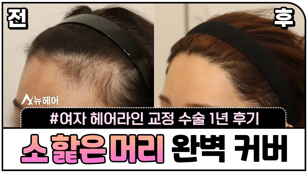 헤어라인교정 1년 후기ㅣ1300모낭 ~ 1600모낭ㅣ뉴헤어