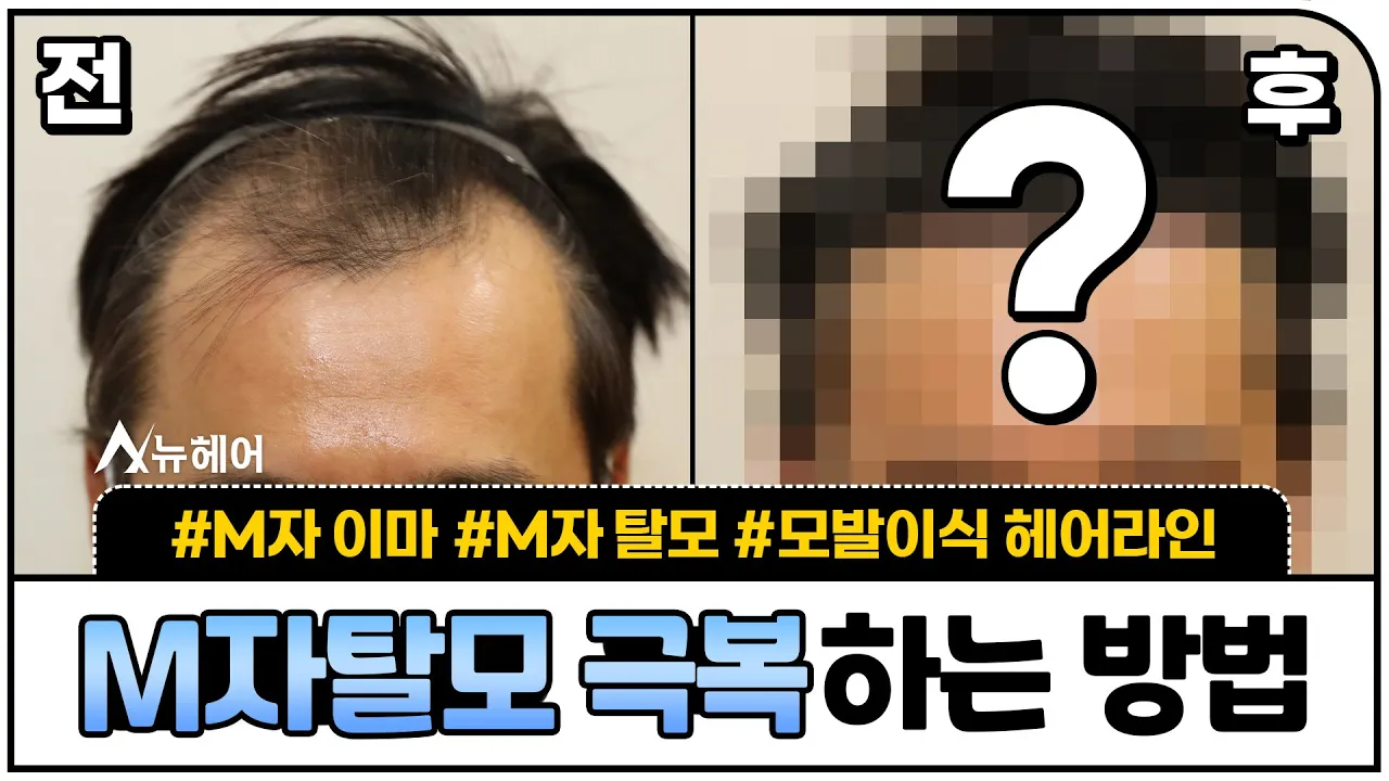 M자탈모 극복 방법! 모발이식 1년 리얼후기ㅣ1400 ~ 2000모낭ㅣ뉴헤어