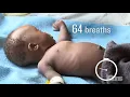 How to count respiration rate and notice chest in-drawing in children