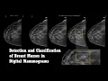 Detection and Classification of Breast Masses in Digital Mammograms