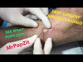 Motorcycle accident compound fracture repair abscess Wait for what POPS out into my hands