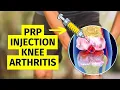 Can PRP Injections ACTUALLY Delay Knee Replacement Surgery