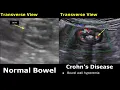 Small Bowel Ultrasound Normal Vs Abnormal Image Appearances Gastrointestinal Tract GIT USG