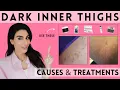 Best Ways to Lighten Dark Inner Thighs Dermatologist Recommended