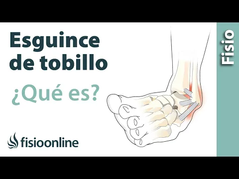 Download MP3 ¿Qué es un esguince de tobillo?