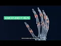 Red Light for Arthritis: Knees Said Yes, Hands Are Split