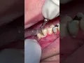 Scaling teeth from tartar and calculus