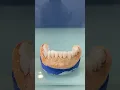Download Lagu Kunsttanden plaatsen op een kliksysteem met tand / gebit implantaten? Van kunstgebit naar klikgebit!