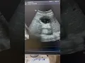 Splenic Abscess
