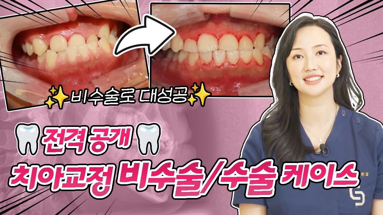 교정하고 얼굴형 완전 달라짐👀✨ 치아교정 수술/비수술 케이스 뜯어보기🦷 #치아교정 #치아교정전후 #비수술 I 스마일뷰치과 러블리 김원장