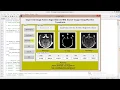 Image Fusion on MRI Images Using DWT PCA Matlab Project with Source Code