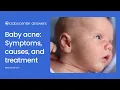Baby acne What it looks like what causes it and how to treat it