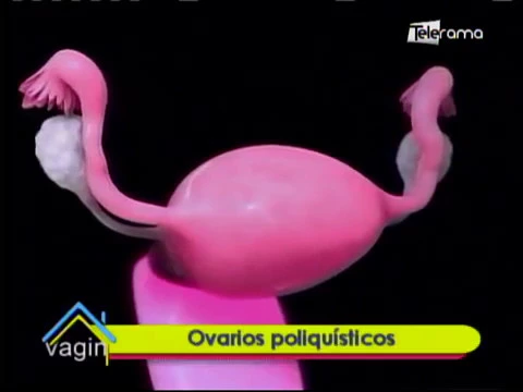 Ovarios poliquísticos
