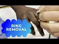 How to get a stuck ring off a swollen finger ring removal