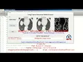 Lung Cancer Detection Using Image Processing With Source Code Lung Cancer Prediction Matlab Project