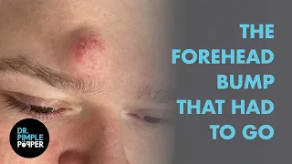 Dr. Pimple Popper vs. The Forehead Bump That Had To Go