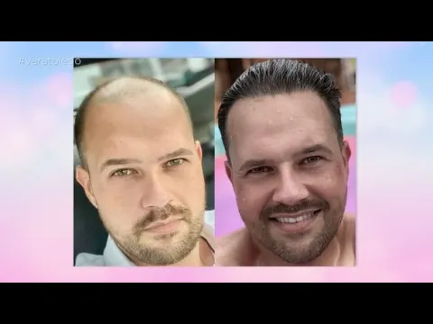 Programa Vera Toledo: Técnica capilar mundialmente conhecida pode ajudar a eliminar a calvície