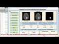 Type of Brain Tumor Detection and Classification Using Matlab Project Source Code
