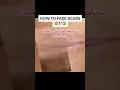 Lagu HOW TO FADE SCARS😨⁉️ #scars #skinexpert #skincareroutine #esthetician
