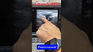  ทำไมหัวแม่เท้าถึงบวมแดงและเจ็บมาก 