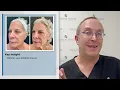 Facial Laser Resurfacing What Patients Need to Know by Jeffrey H Spiegel MD