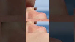 ما تفسير حروق الجلد بسبب الشمس الموجودة على الجسم بعد رحله الى البحر 