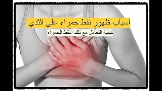 نقط حمراء على الثدي   ما هي أسباب ظهور نقط حمراء على الثدي   كيفية التعامل مع تلك النقط الحمراء دندنها