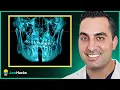 Everything You Need To Know About Mandibular Expansion MSDO