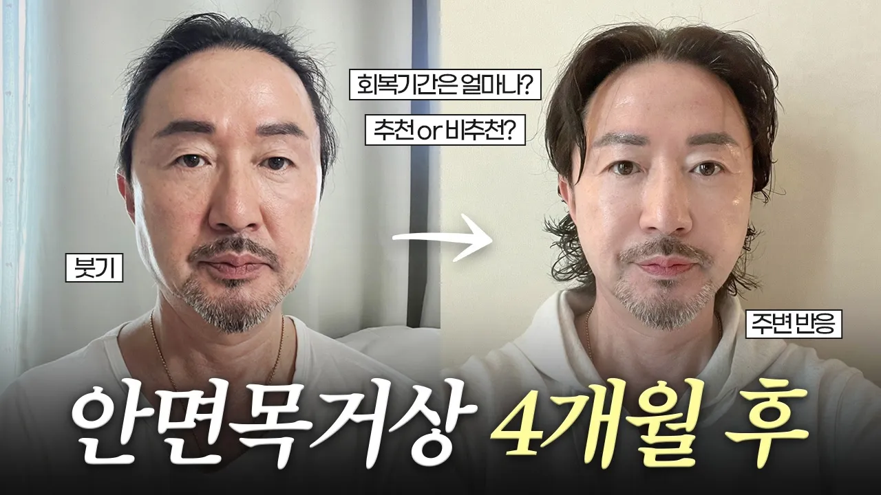 안면거상술, 목거상, 상안검수술 4개월 후기✨｜남자 얼굴처짐부터 목주름, 처진 눈꺼풀 해결!