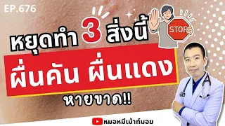 ถ้าผื่นคันไม่หายแม้พยายามหยุดพฤติกรรมทั้ง 3 ข้อ ควรทำอย่างไร?