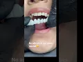 Download Lagu No other cosmetic appliance does this ! Snap-on Smile ❤️