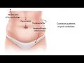 An Approach to Acute Abdominal Pain