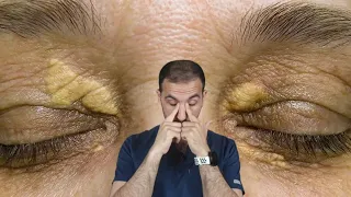 ترسب الدهون حول العين اللويحة الصفراء 