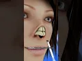 Download Lagu Transform Your Nose with Rhinoplasty #shorts - Creativelearning3d