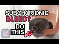Subchorionic hemorrhage in pregnancy Everything to know