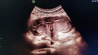 Pyonephrosis with pyelonephritis