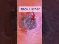 Types of Anthrax (Skin, Lungs, Intestines)