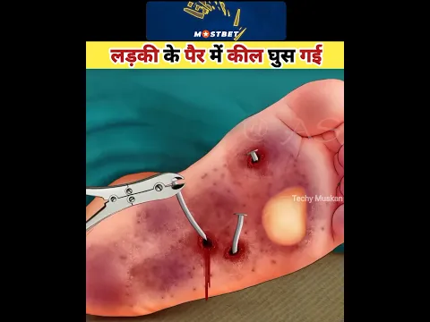 लड़की के पैर में कील घुस गई #asmr #viral