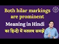 Both hilar markings are prominent meaning in Hindi Both hilar markings are prominent ka matlab