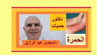 مرض الحمرة بالساق أسبابها ومضاعفاتها وعلاجها معلومات عامه عن الطب Erysipelas Cellulitis 