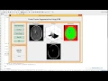 MATLAB code of Brain tumor Detection using SOM detection Segmentation and watershed Transform