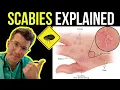 Lagu Doctor explains SCABIES skin rash, including SYMPTOMS, PHOTOS OF SKIN, TREATMENT \u0026 more