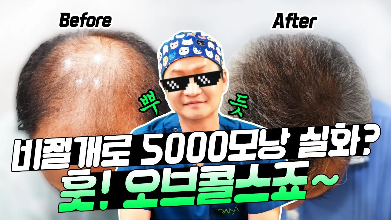 (눈물주의) 촬영 도중 원장님이 💧눈물을 흘린 사연은..?감동의 #대량이식 5000모낭 케이스 리뷰📺ㅣ다나성형외과ㅣ모발이식ㅣ헤어라인교정ㅣ두피문신ㅣ탈모치료ㅣ #모발이식케이스리뷰