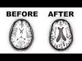 Long-term Effects of Antipsychotics on the Brain