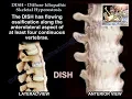 Download Lagu DISH Diffuse Idiopathic Skeletal Hyperostosis - Everything You Need To Know - Dr. Nabil Ebraheim