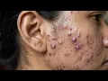 Loan Nguyen Acne Treatment 50ll