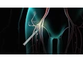 Catheter Ablation
