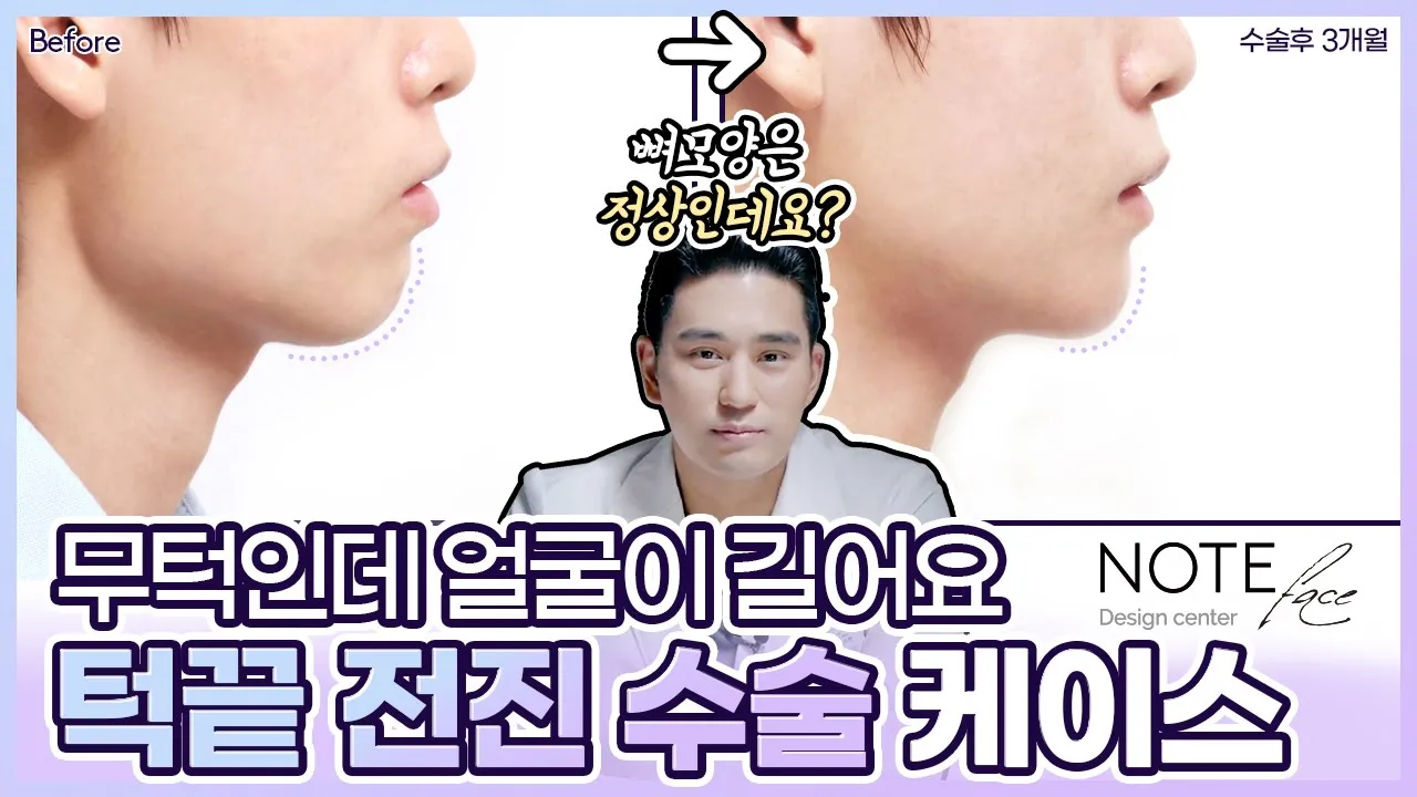 [유.케.리] 📍 CT로 보는 케이스 리뷰 l 긴 얼굴 무턱 l 울퉁불퉁한 얼굴형 l