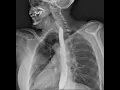 Download Lagu Dynamic X-Ray Retrospective View of the Esophagus in Motion | Konica Minolta Healthcare