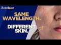 Why Your 1064nm Isn t Treating Melasma the Way You Think